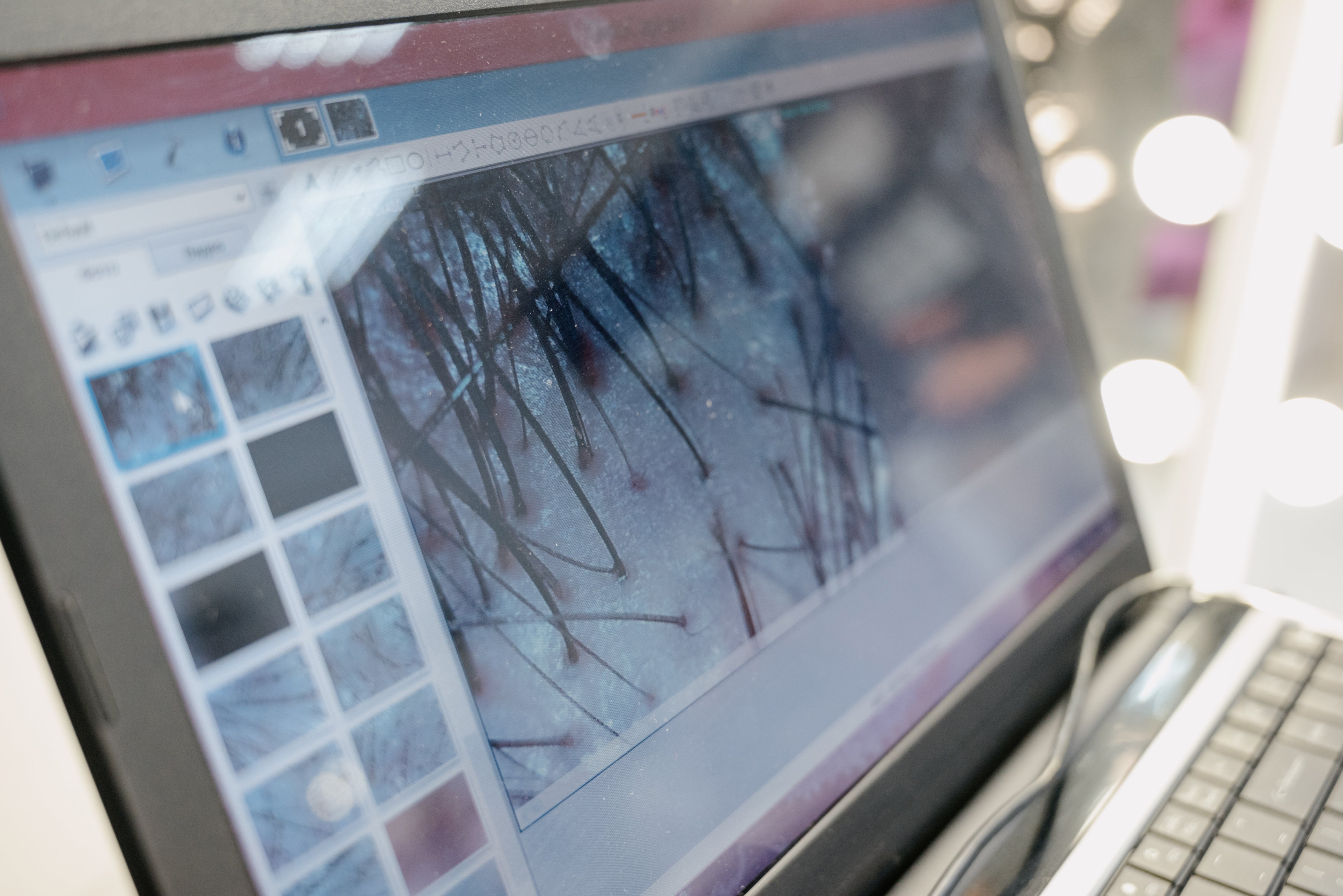 hair follicle analysis using trichoscopy